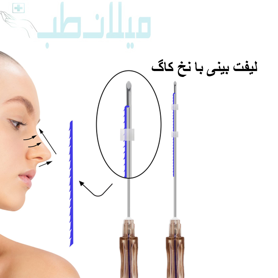 نخ لیفت بینی برند مدیلیفت مدل کاگ  سایز G19.8mm
